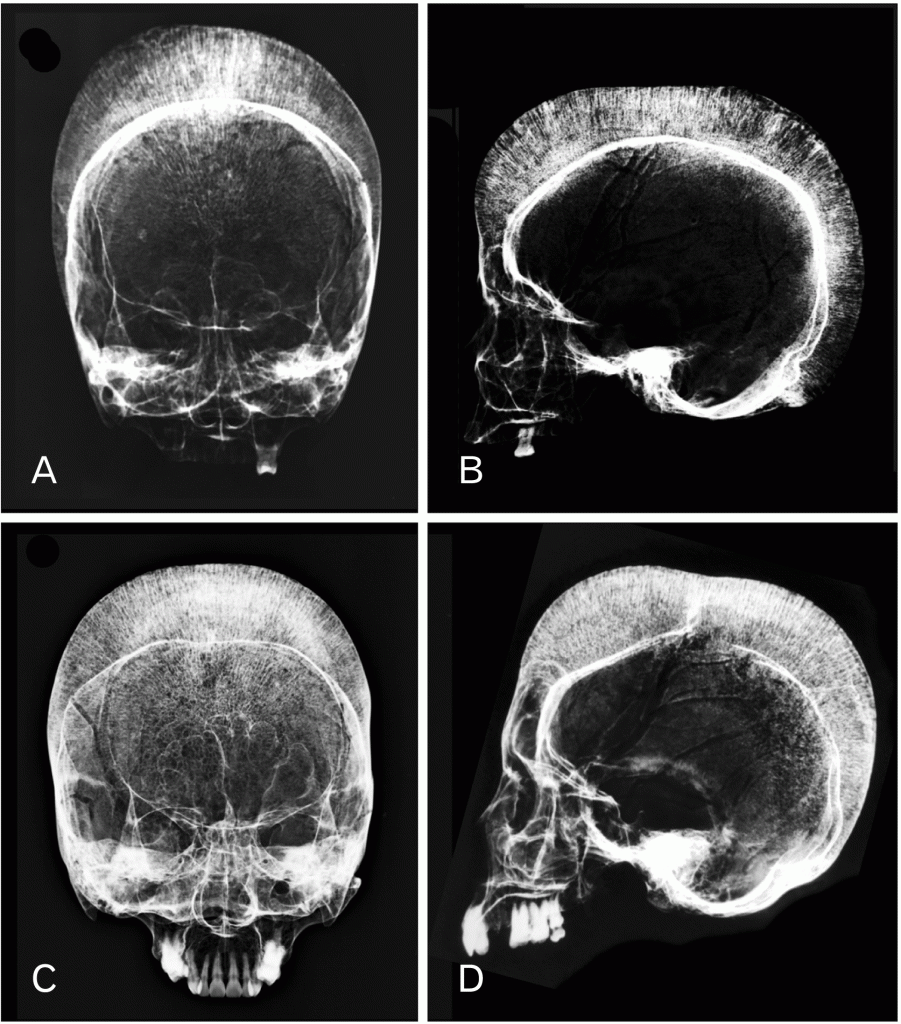 Gross and radiographic appearance of porotic hyperostosis and cribra orbitalia in thalassemia affected skulls